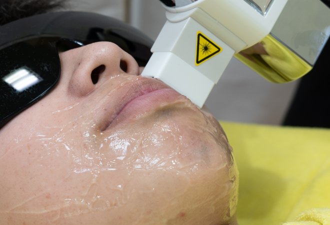 脱毛中の男性のイメージ。